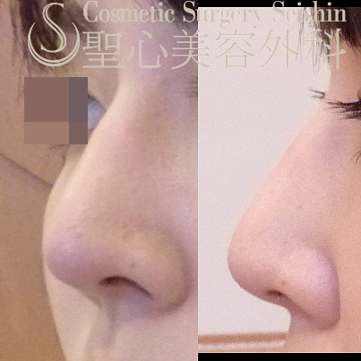 代女性 鷲鼻 わし鼻 の改善 鷲鼻修正 鼻骨 Hump 骨切り術 2ヶ月後 症例写真 美容整形 美容外科なら聖心美容クリニック