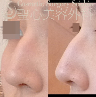 【20代女性・鷲鼻（わし鼻）の改善】 鷲鼻修正（鼻骨 hump 骨切り術）（2ヶ月後） Before 