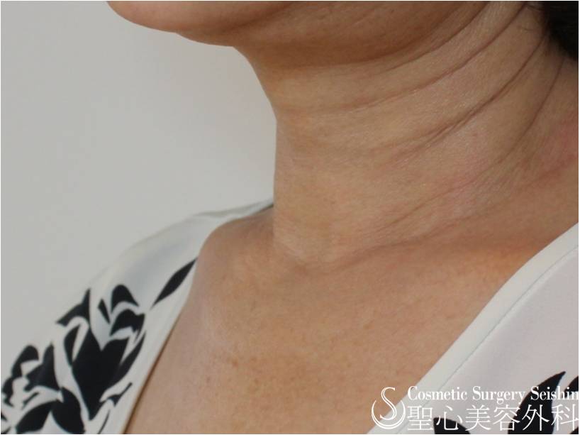 【60代女性・首の横ジワ】プレミアムPRP（1ヶ月後） Before 