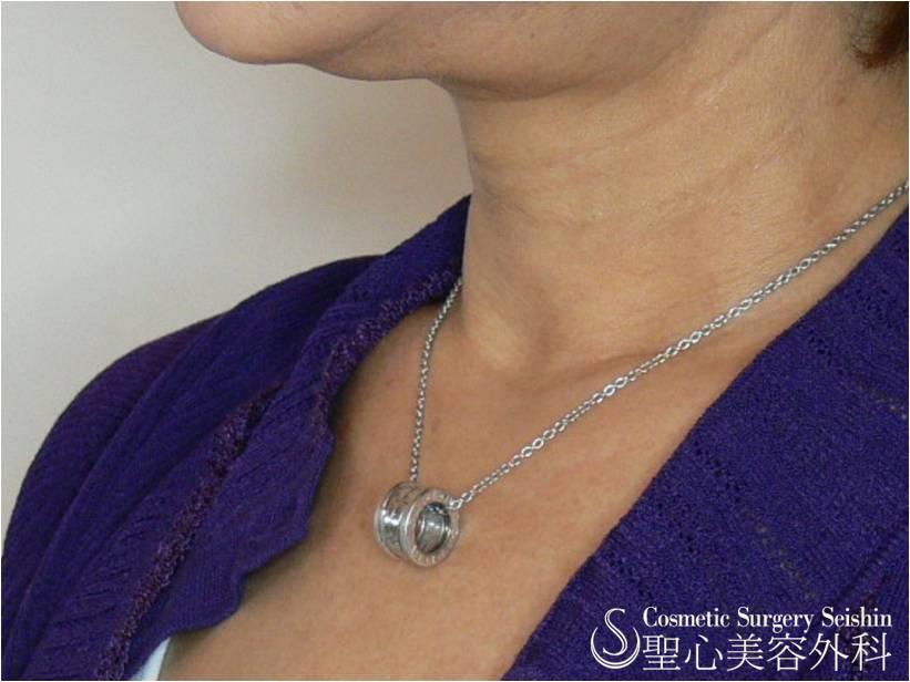 【60代女性・首の横ジワ】プレミアムPRP（1ヶ月後） After 