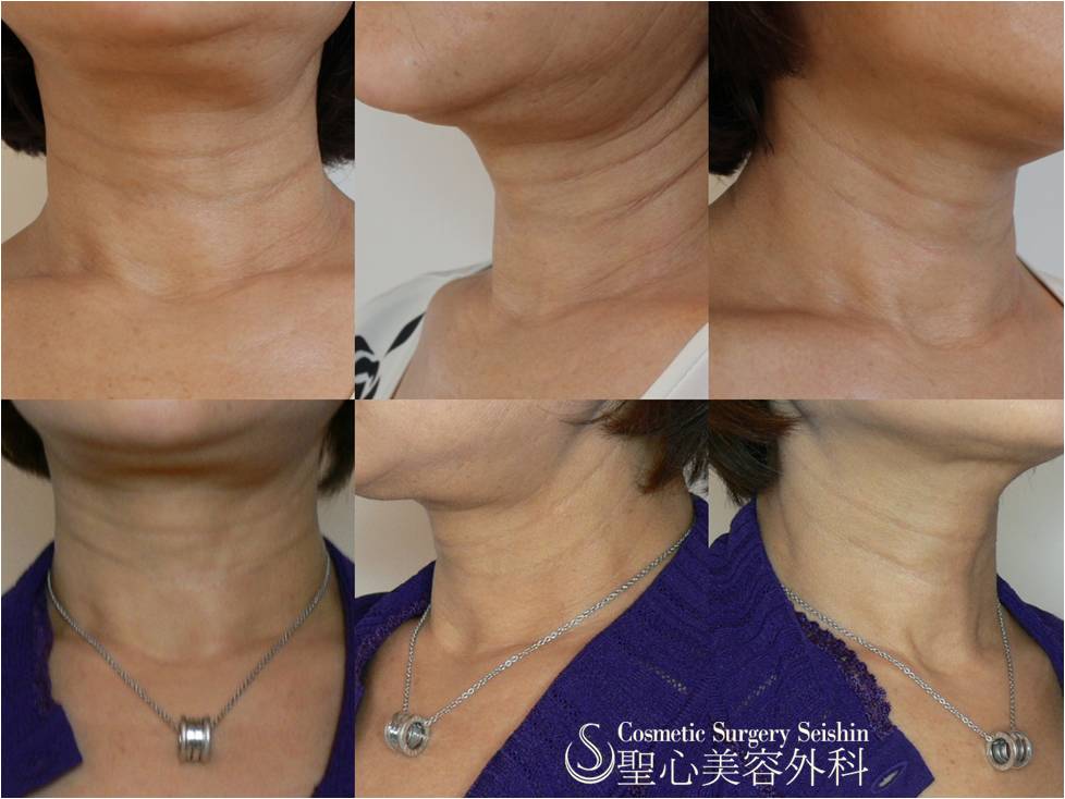 【60代女性・首の横ジワ】プレミアムPRP（1ヶ月後） After 