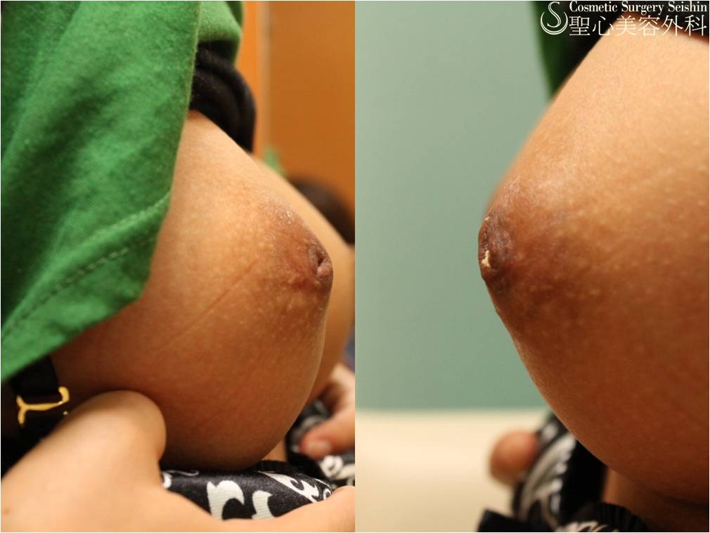 【20代女性：陥没乳頭】陥没乳頭修正術 Before 