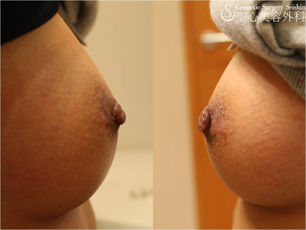 【20代女性：陥没乳頭】陥没乳頭修正術 After 
