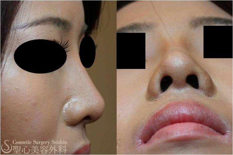 【20代女性・すっきりとした鼻に】鼻プロテーゼ＋小鼻縮小術（1ヶ月後） After 