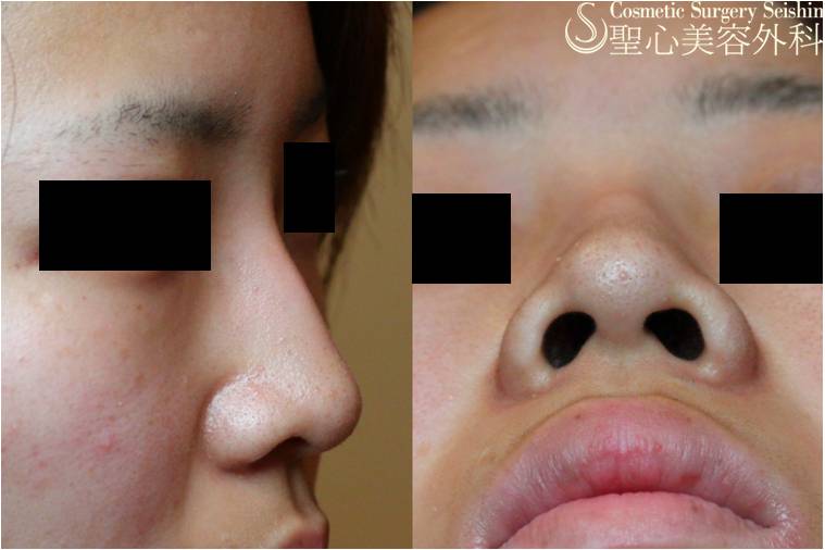 【20代女性・すっきりとした鼻に】鼻プロテーゼ＋小鼻縮小術（1ヶ月後） Before 
