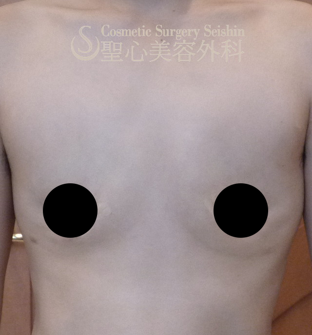 【30代女性・男性のような平らな胸を希望】FTM　乳腺切除＋乳頭縮小＋乳輪縮小（1ヶ月後） After 