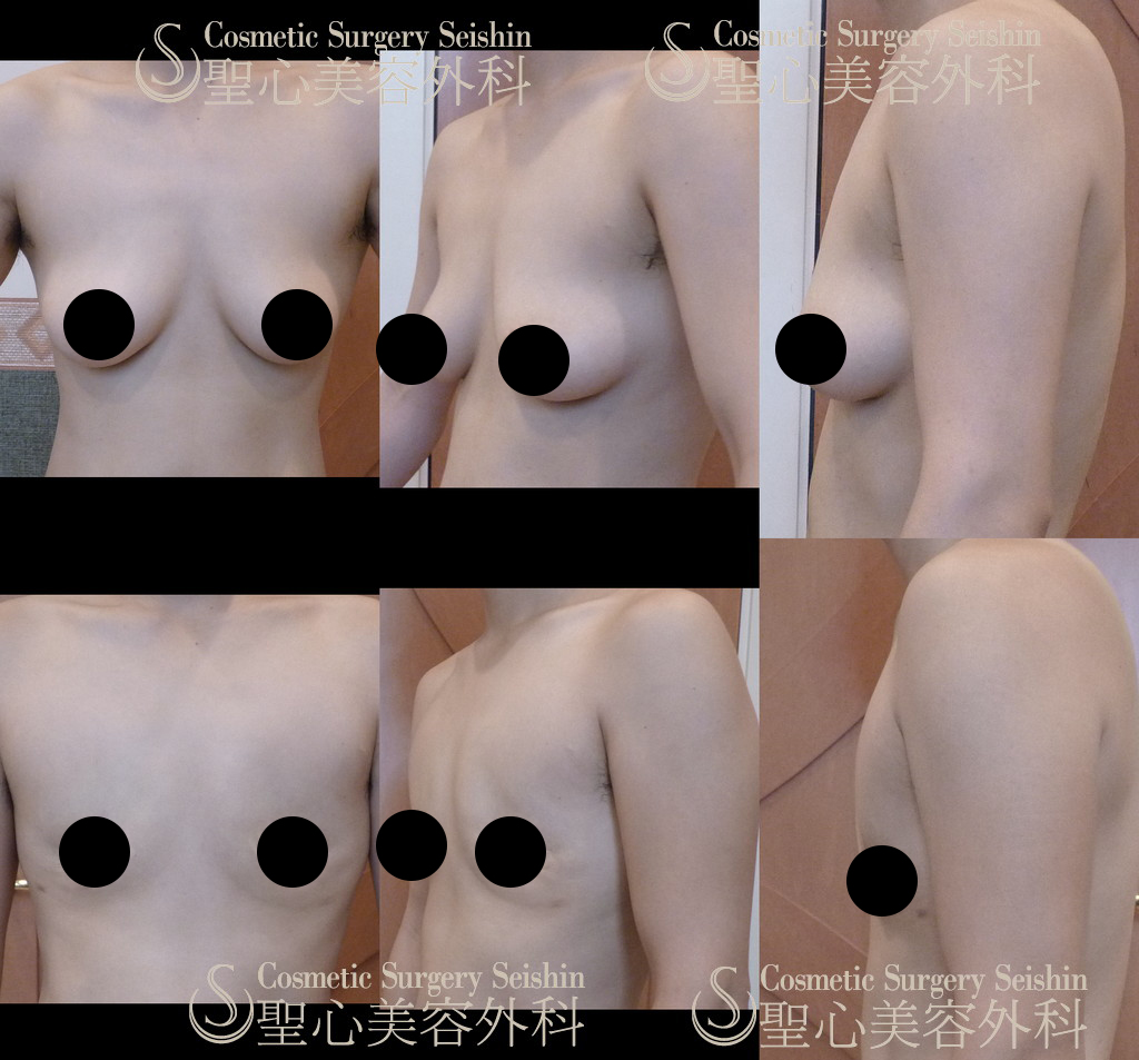 【30代女性・男性のような平らな胸を希望】FTM　乳腺切除＋乳頭縮小＋乳輪縮小（1ヶ月後） After 
