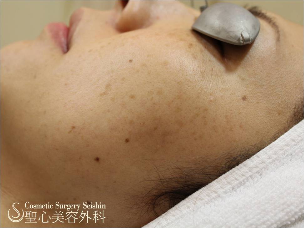 【20代女性・シミ】ライムライト Before 