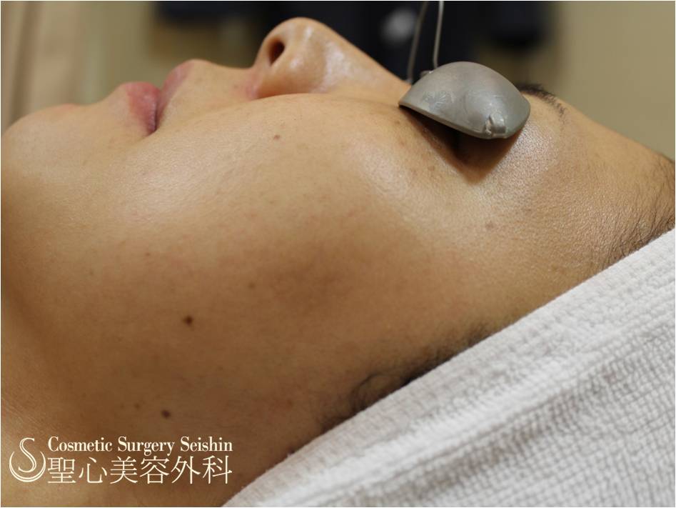 【20代女性・シミ】ライムライト After 