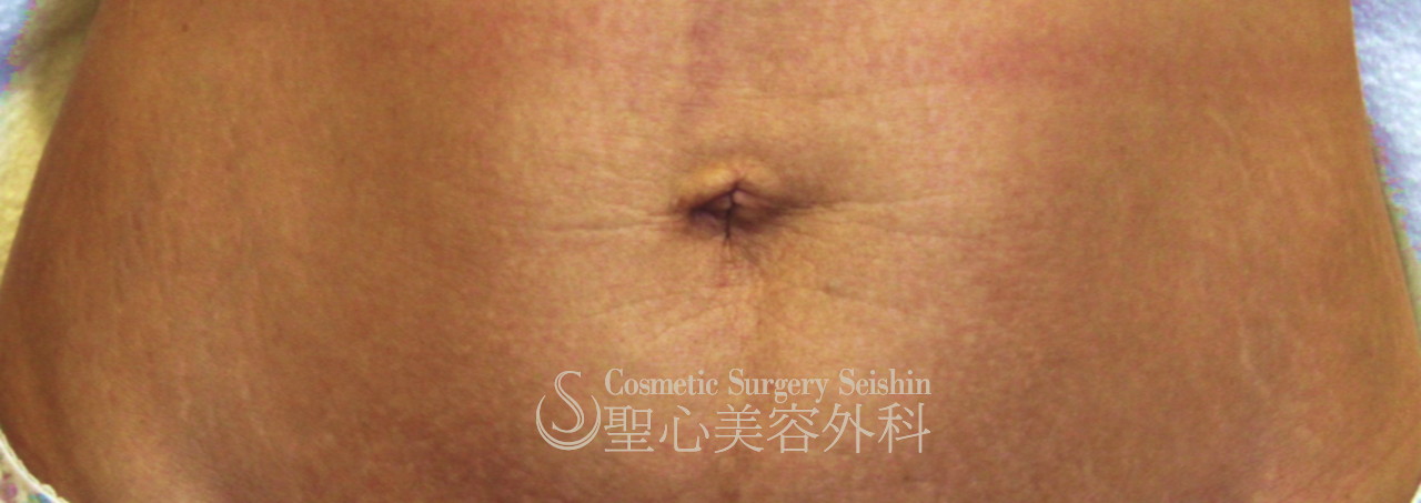 臍の形を整える 出べそ修正 1ヶ月後 症例写真 美容整形 美容外科なら聖心美容クリニック 臍の形を整える 出べそ修正 1ヶ月後 症例写真 美容整形 美容外科なら聖心美容クリニック