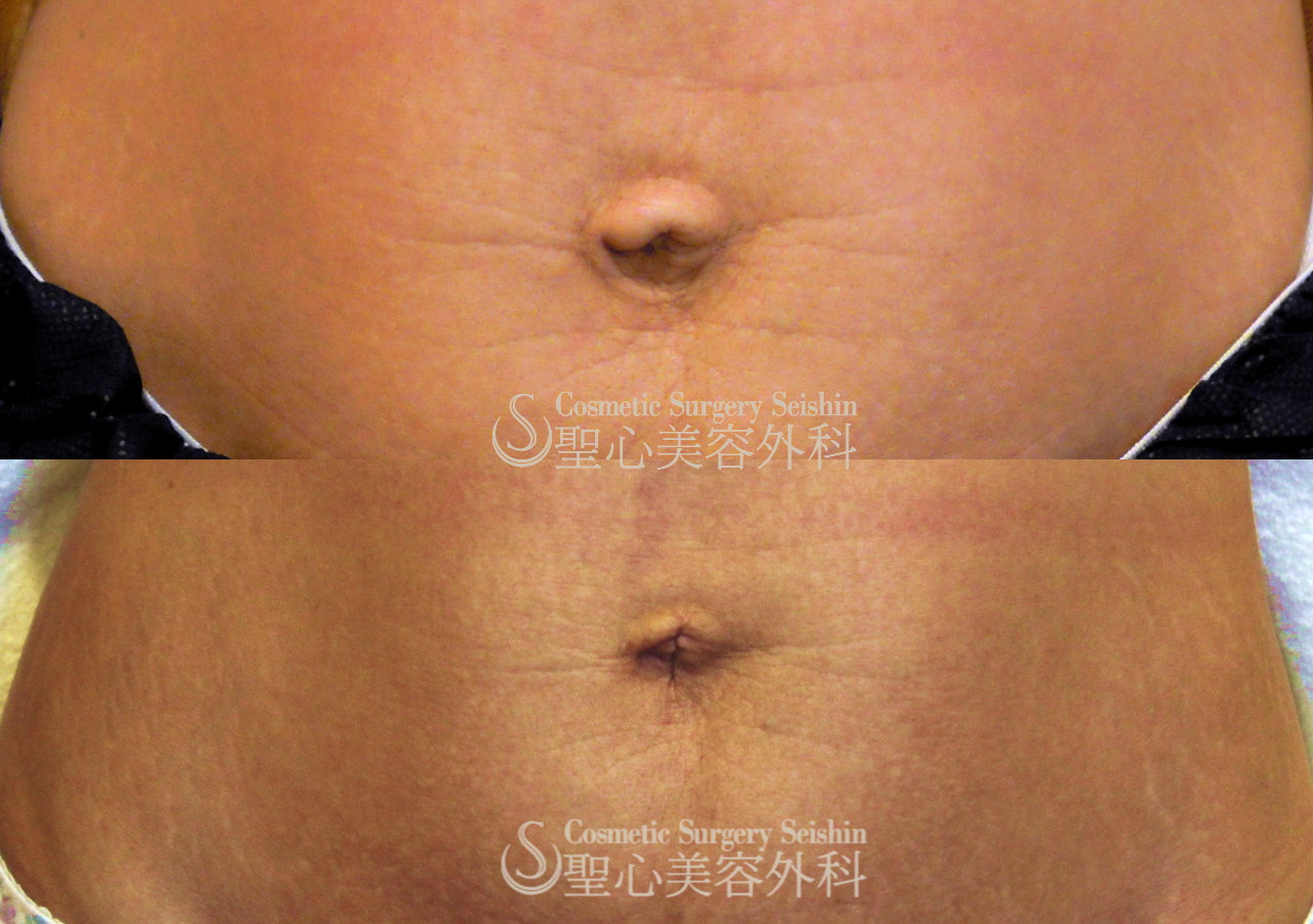 【臍の形を整える】出べそ修正（1ヶ月後） After 