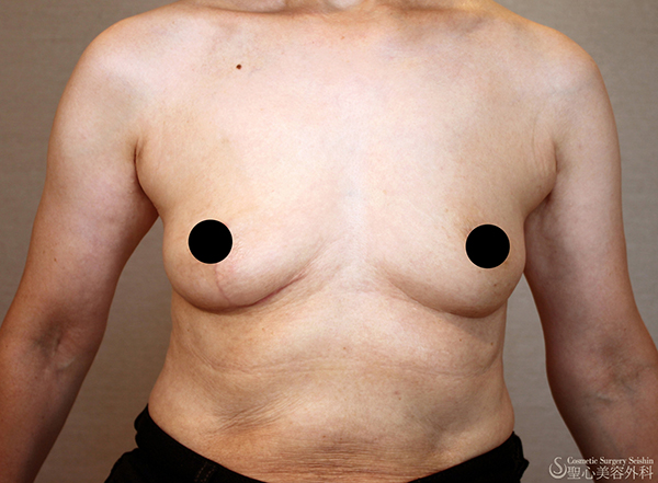 【60代女性・バストの左右差】乳房吊り上げ術（3ヶ月後） After 