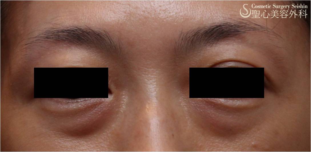 【手術直後の状態】目の下脂肪取り／経結膜脱脂法（施術直後） Before 