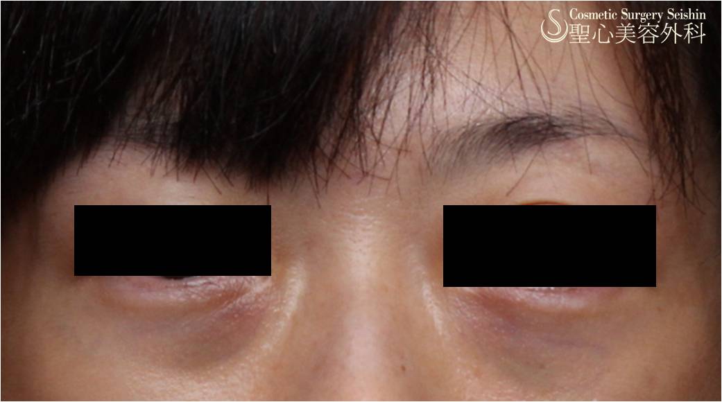 【手術直後の状態】目の下脂肪取り／経結膜脱脂法（施術直後） After 
