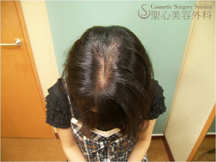 代女性 薄毛 パントガール 6ヶ月後 Kipスカルプエッセンス 使用2ヶ月後 症例写真 美容整形 美容外科なら聖心美容クリニック