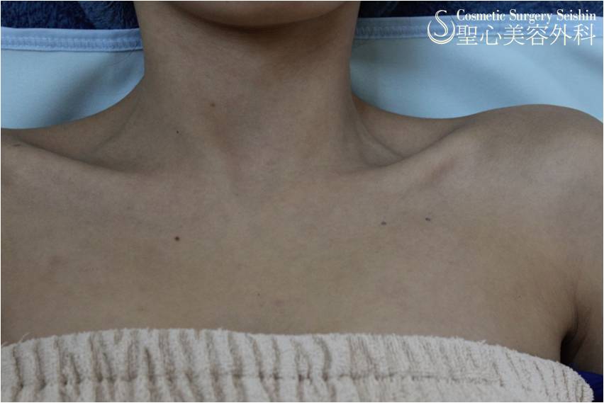 【20代女性・ボディピアス】鎖骨下ピアス Before 