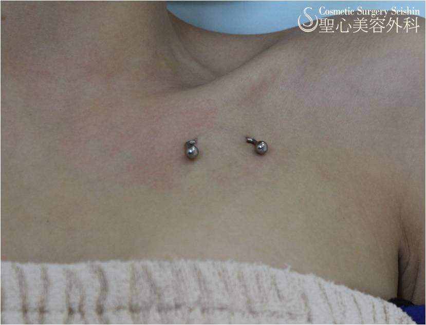 【20代女性・ボディピアス】鎖骨下ピアス After 