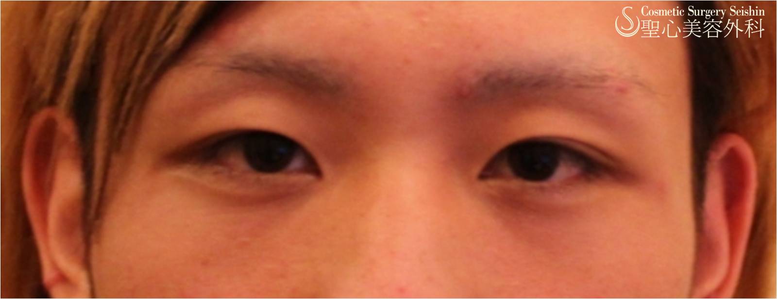 【20代男性・キリットした目に】二重埋没法＋目頭切開 Before 