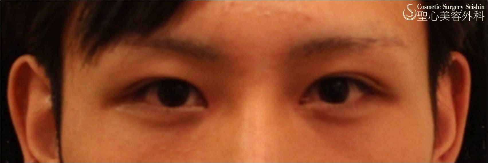 【20代男性・キリットした目に】二重埋没法＋目頭切開 After 