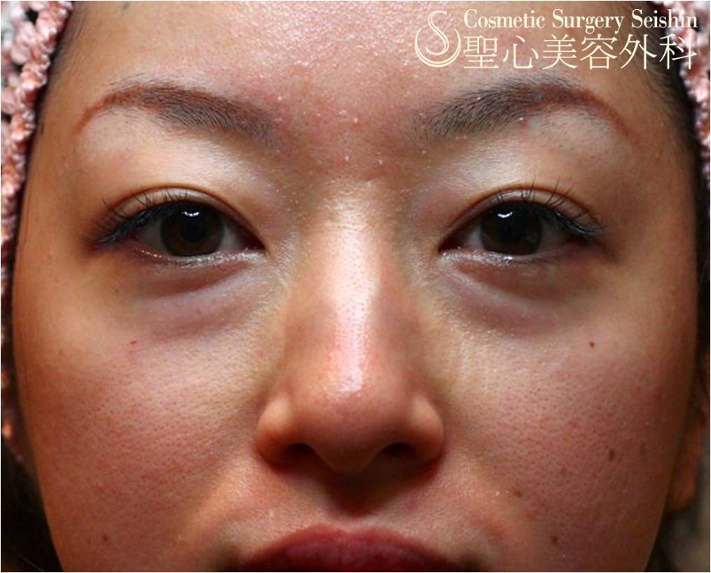 【20代女性スタッフ】目の下のクマ（プレミアムPRP皮膚再生療法＋経結膜的脱脂術） Before 