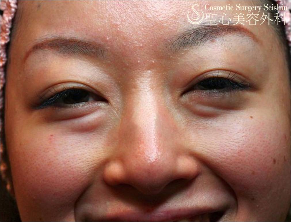 【20代女性スタッフ】目の下のクマ（プレミアムPRP皮膚再生療法＋経結膜的脱脂術） Before 