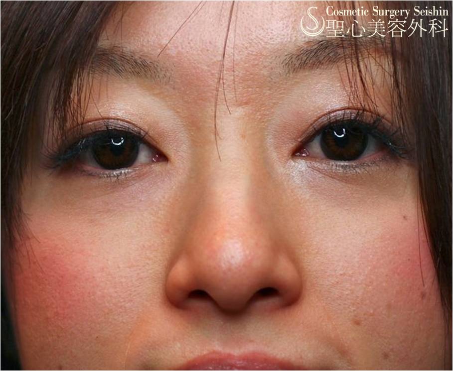 【20代女性スタッフ】目の下のクマ（プレミアムPRP皮膚再生療法＋経結膜的脱脂術） After 