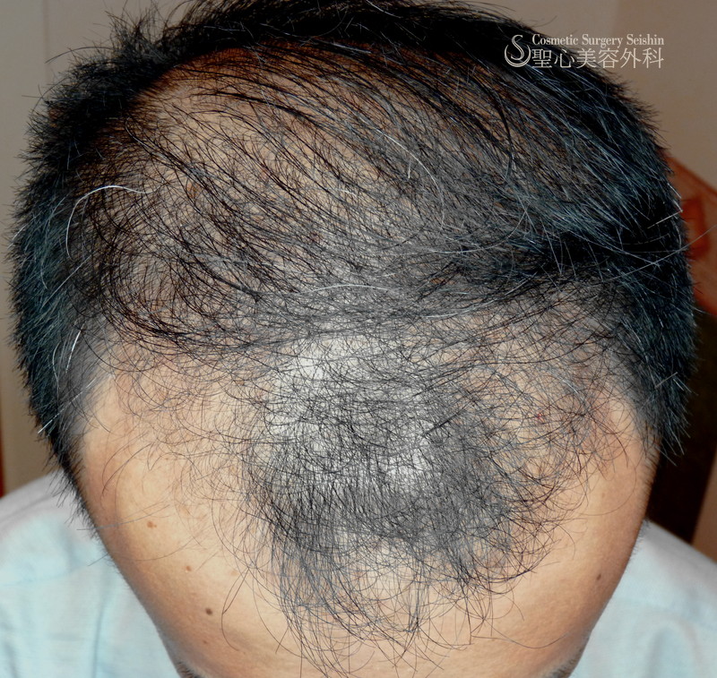 【30代男性・薄毛の治療目的】グロースファクター毛髪再生療法＋KIPスカルプヘアエッセンスの外用（6ヶ月後） Before 