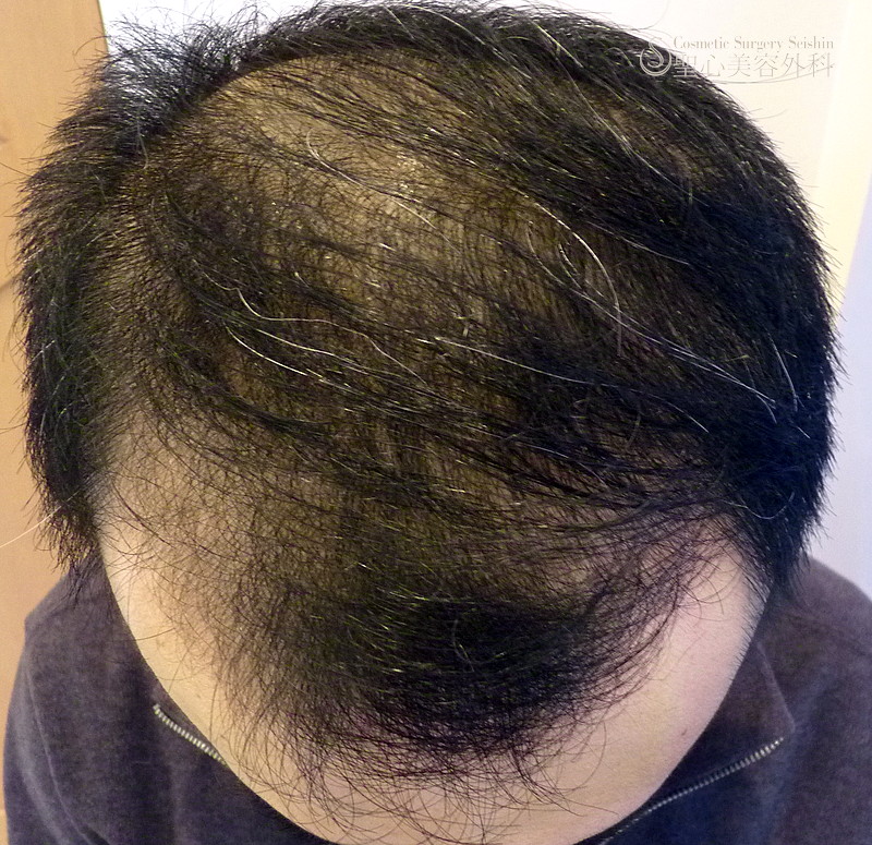 【30代男性・薄毛の治療目的】グロースファクター毛髪再生療法＋KIPスカルプヘアエッセンスの外用（6ヶ月後） After 