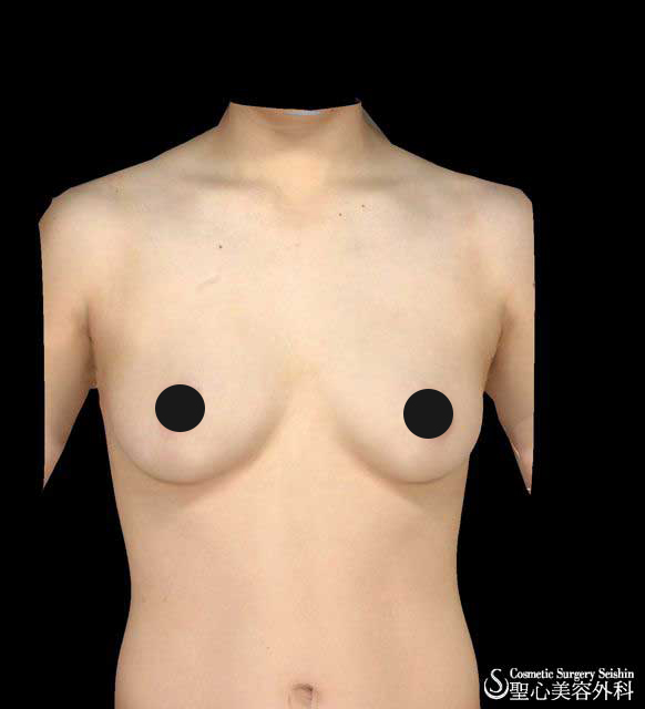 乳腺切除　性同一性障害 Before 