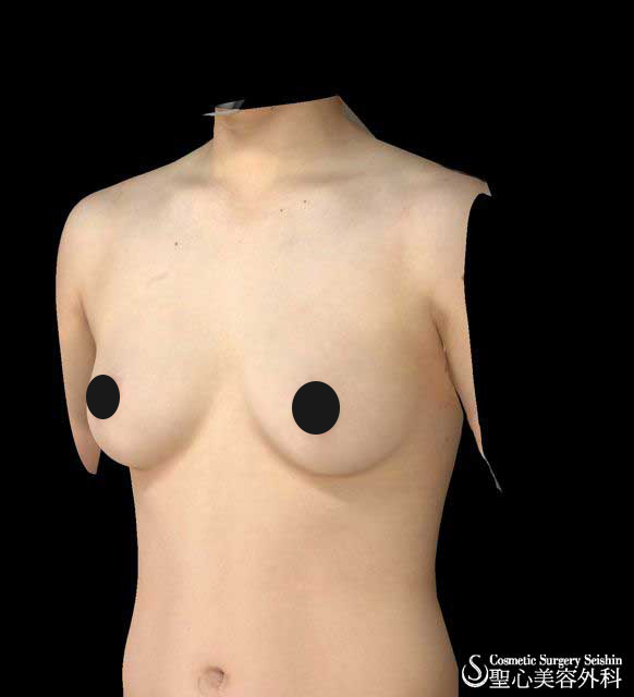 乳腺切除　性同一性障害 Before 