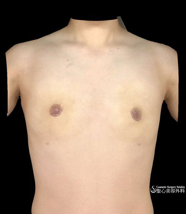 乳腺切除　性同一性障害 After 