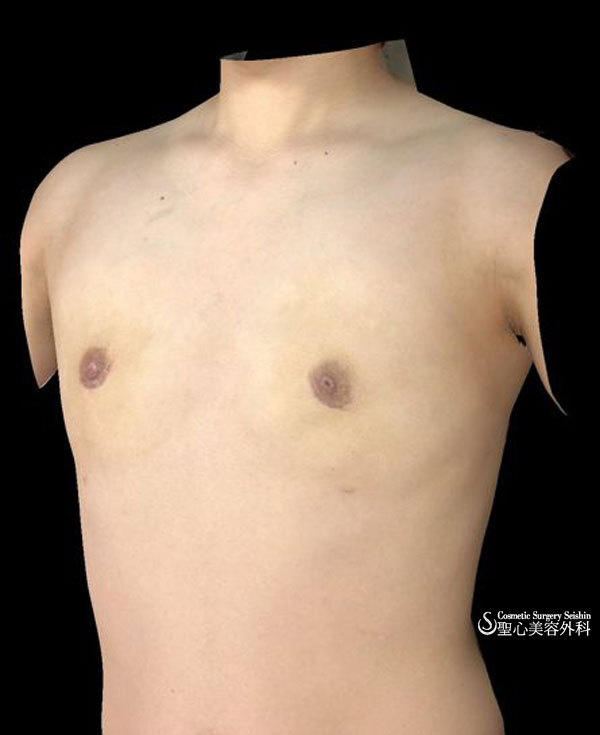 乳腺切除　性同一性障害 After 