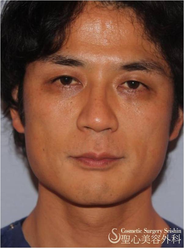 【大阪院の寺町院長が体験】ドクターハイフ（ウルセラシステム）（腫れない超音波リフトアップ） After 