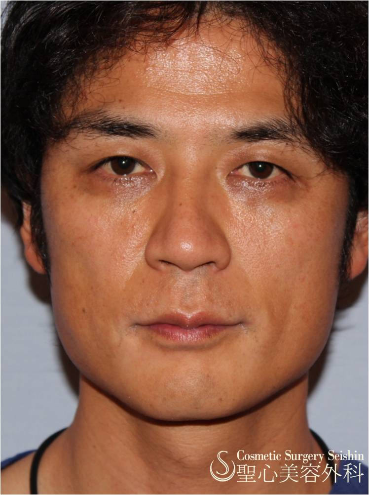 【大阪院の寺町院長が体験】ドクターハイフ（ウルセラシステム）（腫れない超音波リフトアップ） Before 