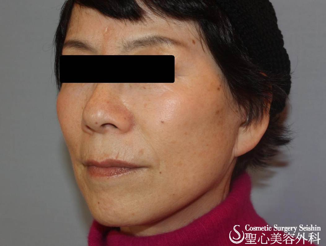 60代女性 フェイスリフト 症例写真 美容整形 美容外科なら聖心美容クリニック 60代女性 フェイスリフト 症例写真 美容整形 美容外科なら聖心美容クリニック