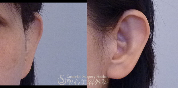 【30代女性】立ち耳修正（切開法）（1ヶ月後） Before 