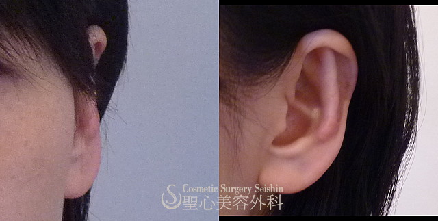 【30代女性】立ち耳修正（切開法）（1ヶ月後） After 