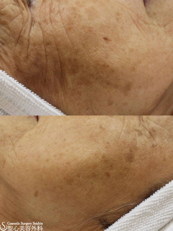 【70代女性・顔のシミ】ライムライト Before 