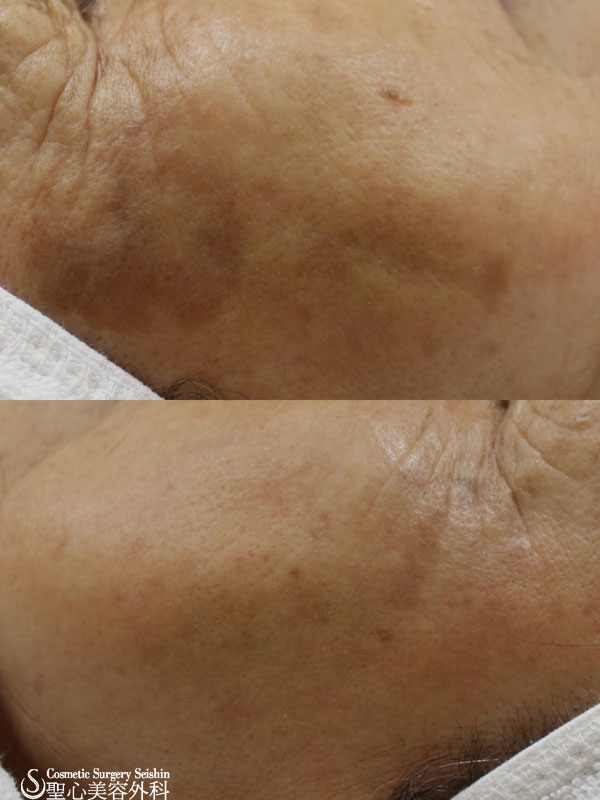 【70代女性・顔のシミ】ライムライト After 