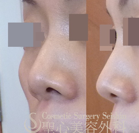 40代女性 鼻先を下向きに出す 鼻尖形成 耳介軟骨移植 鼻尖 鼻柱へ 1ヶ月後 症例写真 美容整形 美容外科なら聖心美容クリニック