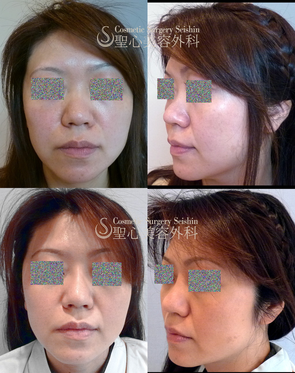 【40代女性・鼻筋を通したい】シリコンプロテーゼによる隆鼻術（1ヶ月後） After 