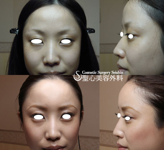 ２０代女性 おでこを丸く ヒアルロン注入 症例写真 美容整形 美容外科なら聖心美容クリニック