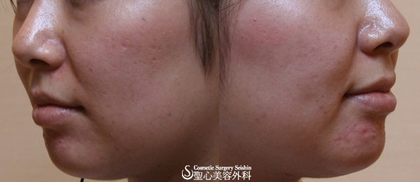 【30代女性・アキュパンクチュアリフト1ヶ月】マリオネットライン Before 