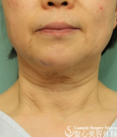 58歳女性 首のたるみ しわ ネックリフト 症例写真 美容整形 美容外科なら聖心美容クリニック