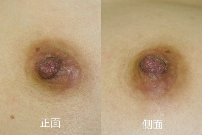 【20代女性 陥没乳頭】酒井Ⅱ法 After 