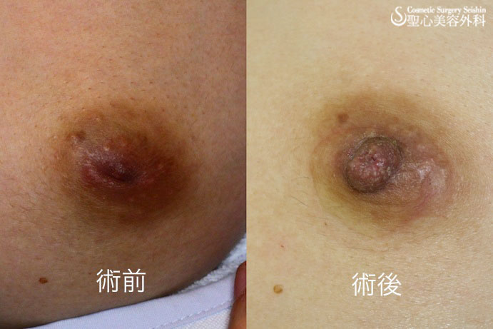 【20代女性 陥没乳頭】酒井Ⅱ法 After 
