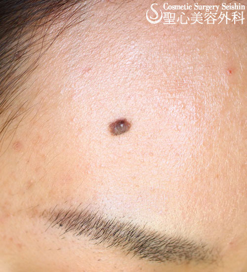 【20代女性 ほくろ、イボ】電気凝固法 Before 