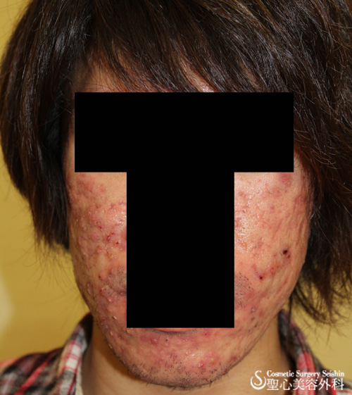 【20代男性・ひどいニキビ】オバジ・クレンジダームMD（2ヶ月後） Before 