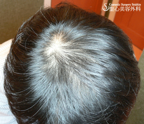 【30代・男性】AGA(男性型脱毛症）治療 Before 