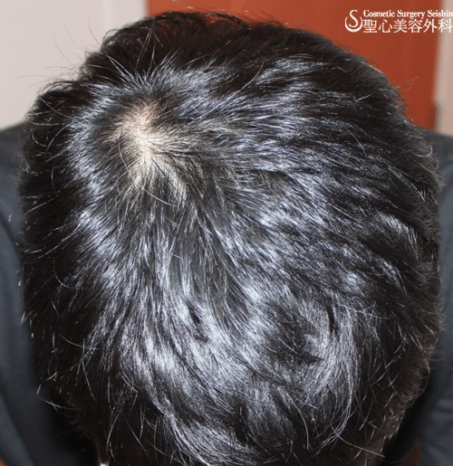 【30代・男性】AGA(男性型脱毛症）治療 After 